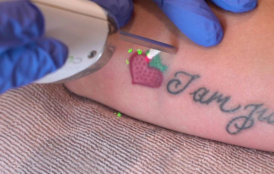 Съемка удаления татуировки повреждает камеру